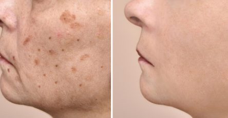 Como eliminar manchas oscuras en la cara 42868 orig