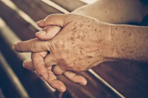 Eliminar las manchas la edad la piel
