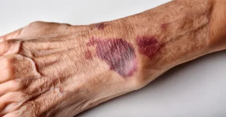 Hematoma mano anciana 768x434