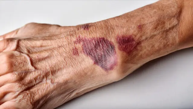 Hematoma mano anciana 768x434