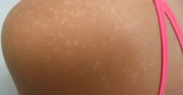 Pitiriasis versicolor