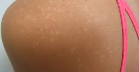 Pitiriasis versicolor