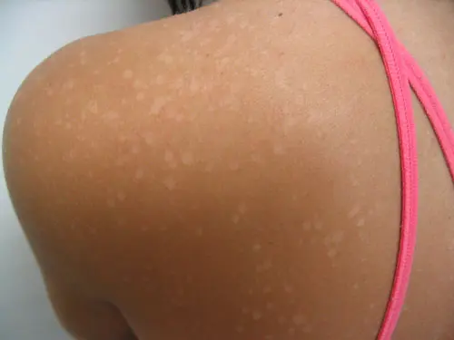 Pitiriasis versicolor