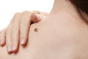 Verruga espalda de mujer 768x512
